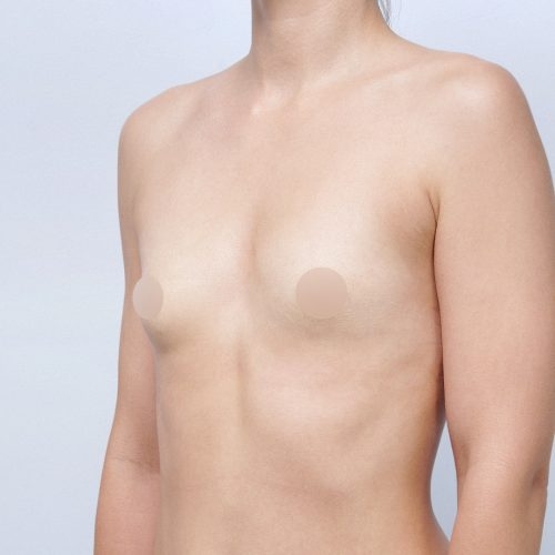 michal-powiekszenie-piersi-implantami-id70865-19e-aspect-ratio-500-500