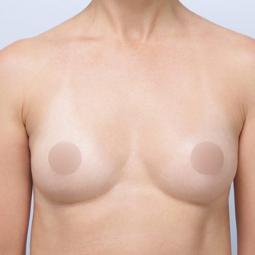 michal-powiekszenie-piersi-implantami-id72276-18a-aspect-ratio-500-500