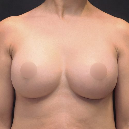 michal-powiekszenie-piersi-implantami-id72276-18b-aspect-ratio-500-500