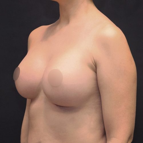 michal-powiekszenie-piersi-implantami-id72276-18d-aspect-ratio-500-500