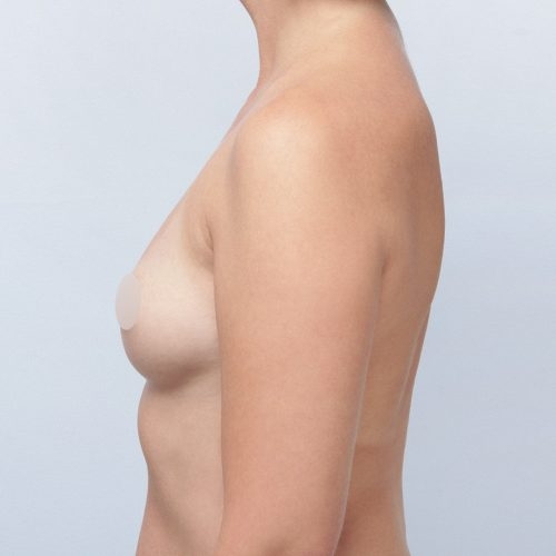michal-powiekszenie-piersi-implantami-id72276-18e-aspect-ratio-500-500