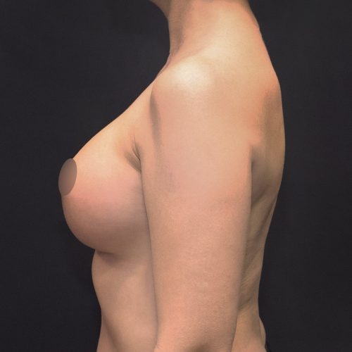michal-powiekszenie-piersi-implantami-id72276-18f-aspect-ratio-500-500