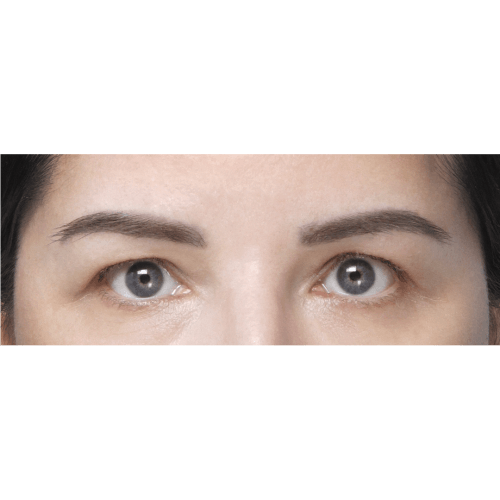 miszczyk-brow-lift-powieki-gorne-id79517-2a-aspect-ratio-500-500