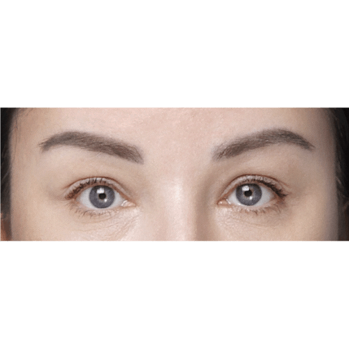 miszczyk-brow-lift-powieki-gorne-id79517-2b-aspect-ratio-500-500