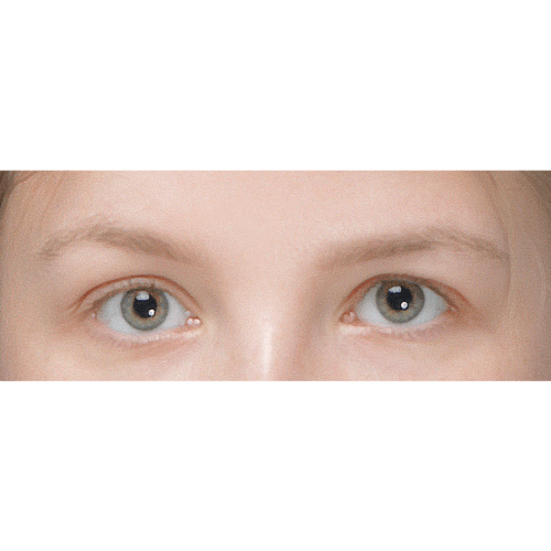 miszczyk-endoskopowy-lifting-brwi-id78194-25a-aspect-ratio-500-500