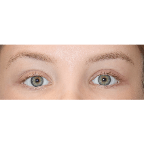 miszczyk-endoskopowy-lifting-brwi-id78194-25b-aspect-ratio-500-500