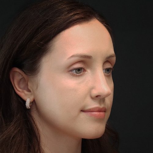 michal-korekcja-nosa-zgoda-44f-aspect-ratio-500-500