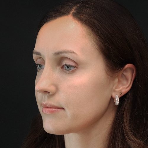michal-korekcja-nosa-zgoda-44h-aspect-ratio-500-500