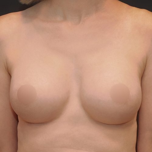 michal-powiekszenie-piersi-implantami-id71795-23b-aspect-ratio-500-500