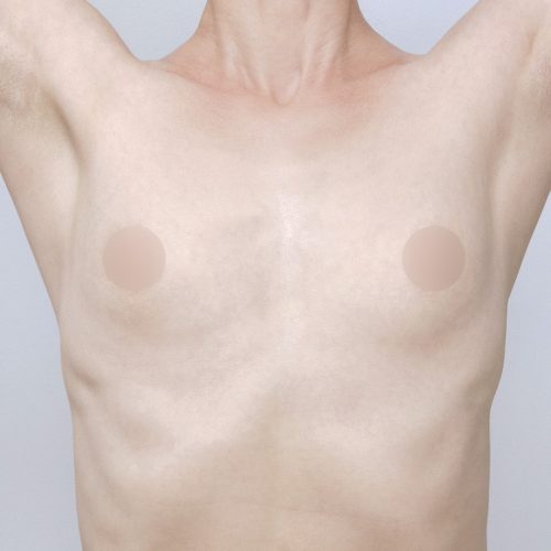 michal-powiekszenie-piersi-implantami-id71795-23c-aspect-ratio-500-500
