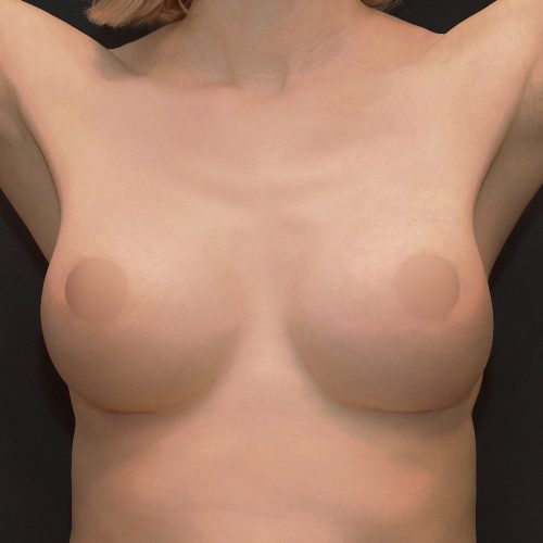 michal-powiekszenie-piersi-implantami-id71795-23d-aspect-ratio-500-500