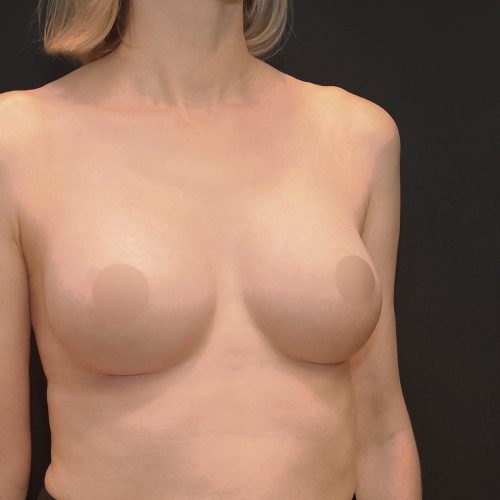 michal-powiekszenie-piersi-implantami-id71795-23f-aspect-ratio-500-500