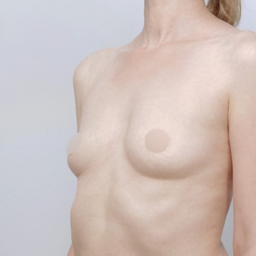 michal-powiekszenie-piersi-implantami-id71795-23g-aspect-ratio-500-500