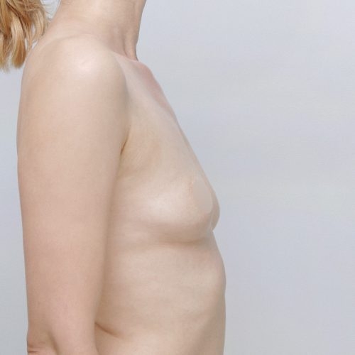 michal-powiekszenie-piersi-implantami-id71795-23i-aspect-ratio-500-500