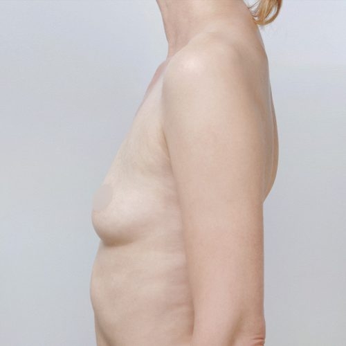 michal-powiekszenie-piersi-implantami-id71795-23k-aspect-ratio-500-500
