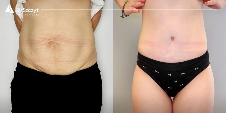Vor und nach der Bauchdeckenstraffung