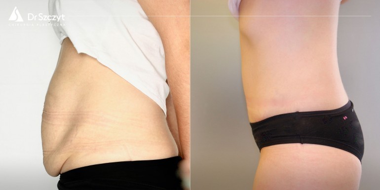 Vor und nach der Bauchdeckenstraffung
