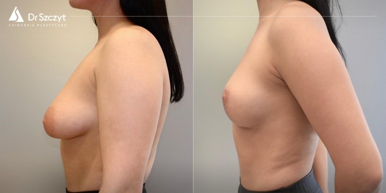 Breast lift before and after