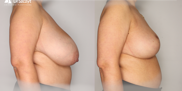 Breast reduction before and after