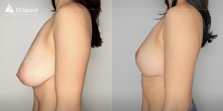 Breast-reduction-before-after