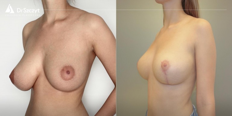 Breast-reduction-before-after
