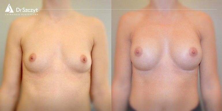 Vor und nach der Brustvergrößerung mit Implantaten