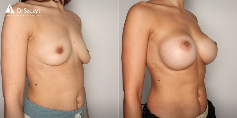 Vor und nach der Brustvergrößerung mit Implantaten