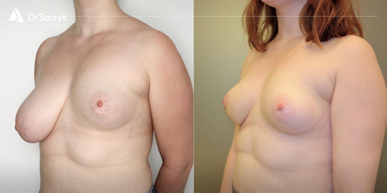 Vor und nach der Brustverkleinerung