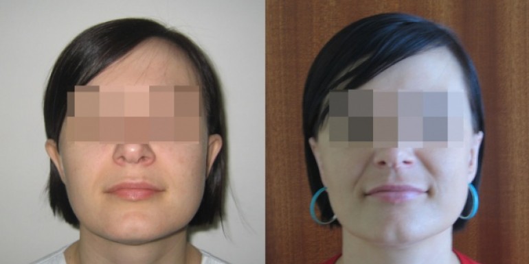 Ear reshaping surgery after and before