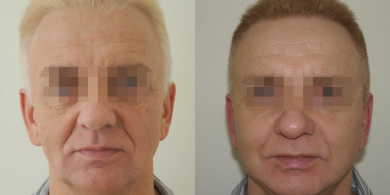 Face lift surgery before and after