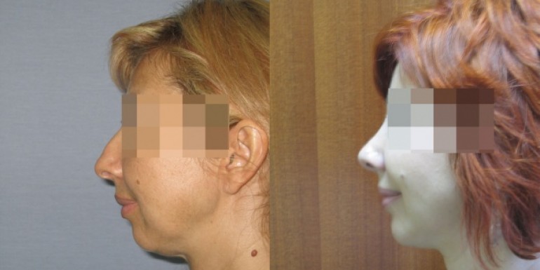 Facial implants before and after