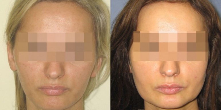 Facial implants before and after