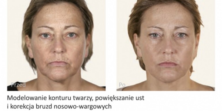 Hyaluronic Acid before and after