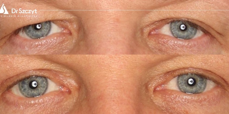 Vor und nach der Augenlidplastik