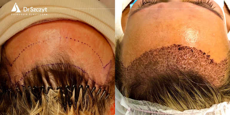 Vor und nach der Haartransplantation