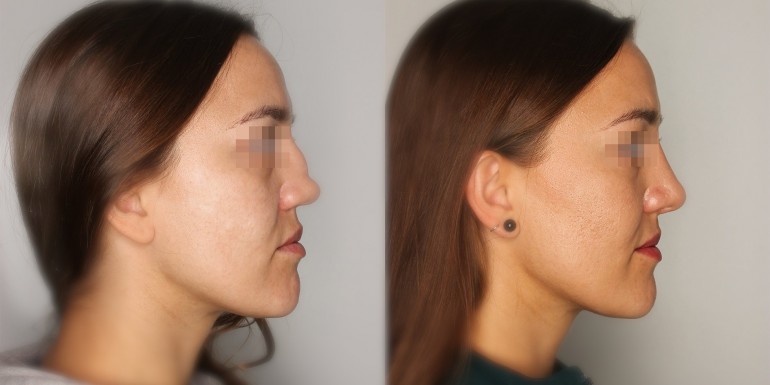 Vor und nach der Nasenoperation
