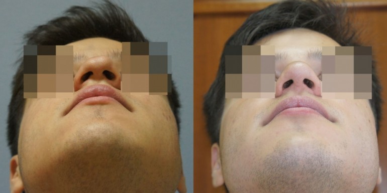 Vor und nach der Nasenoperation