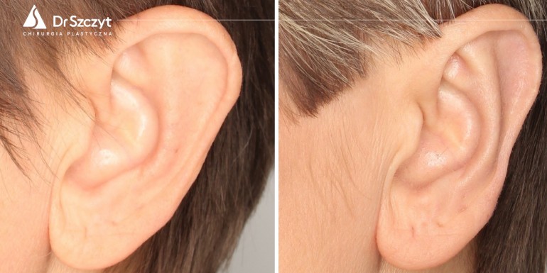 Vor und nach der Ohrenoperation