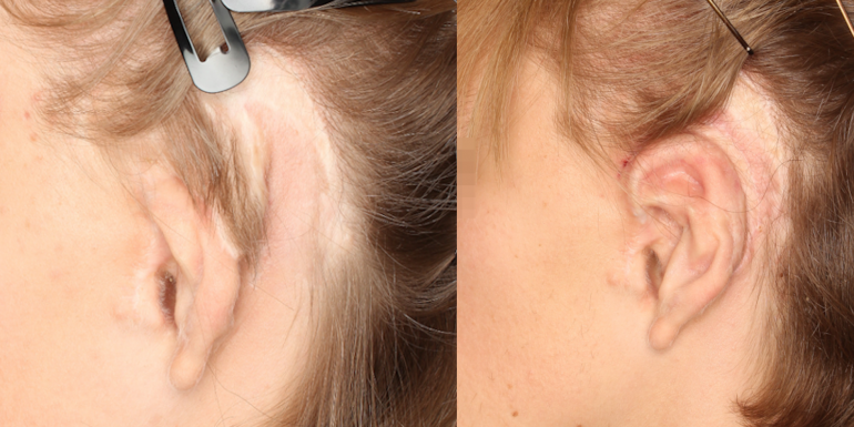 Vor und nach der Ohrrekonstruktion