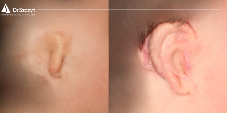 Vor und nach der Ohrrekonstruktion